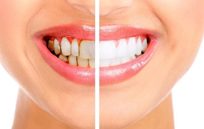 Affordable-Dental-Cleaning-And-Teeth-Whitening-Treatment-In-Brampton-