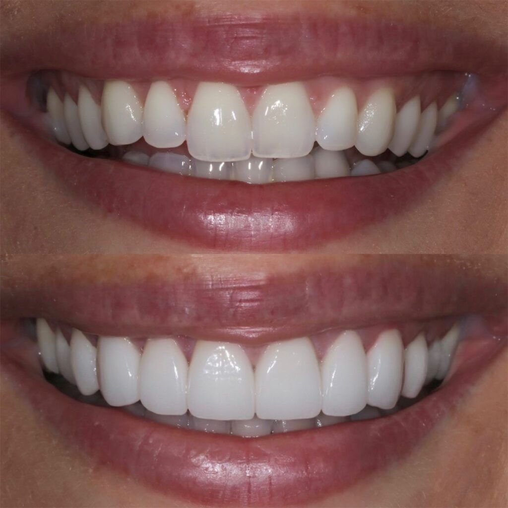 COSMETIC-TOOTH-RESHAPING