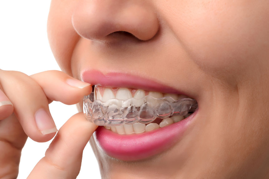 NVISALIGN-BRACES-Mayfield-Dental