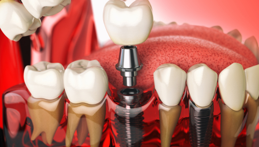 Bone Grafting Material Placement