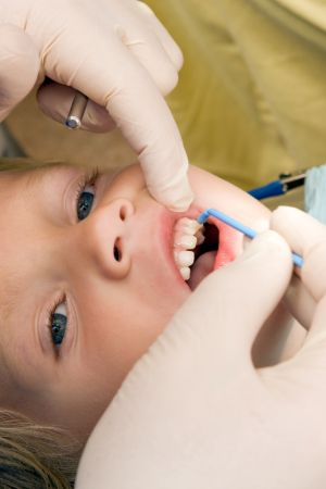 Fluoride Varnish