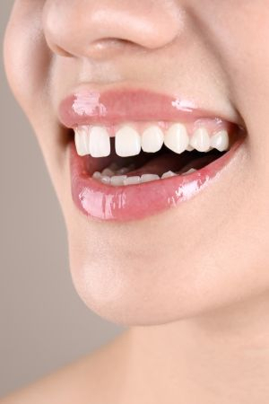 Gaps between teeth reopening