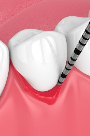 Gum disease causing bone damage