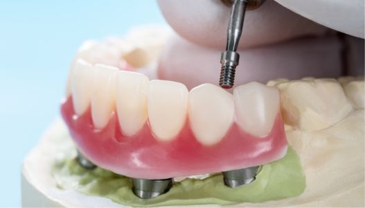 Implant Supported Dentures