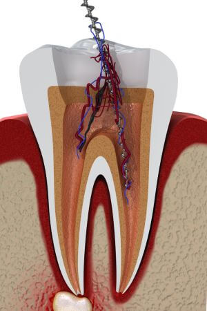 Sealing the Root