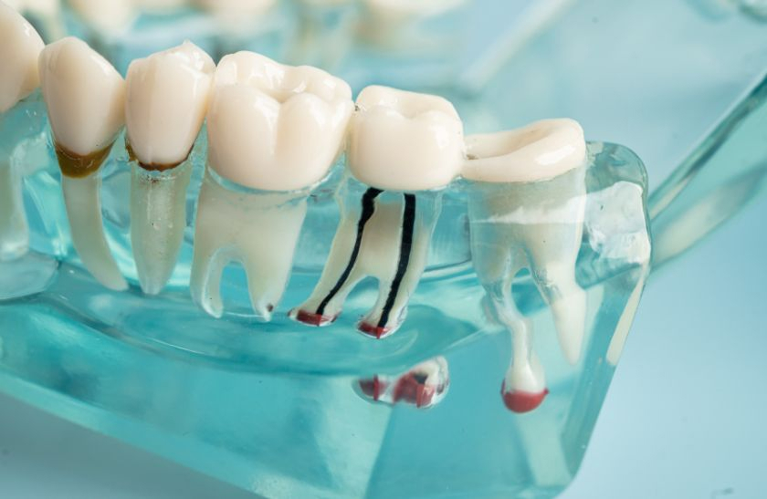 When a Root Canal Is Not Enough